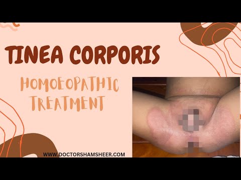 TINEA CORPORIS