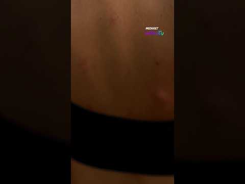 María Jesús sufre con la cantidad de picadas que tiene en todo el cuerpo: «Tengo 40 más»