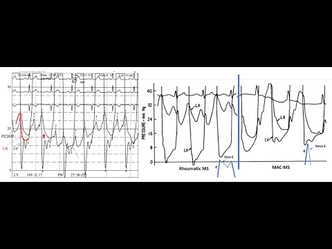 Hemodynamics: valve area calculation, mitral stenosis and regurgitation - Elias Hanna, Univ of Iowa