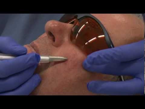 Couperose - Entfernung von Äderchen und Rötungen im Gesicht