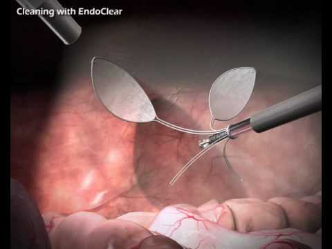 EndoClear™ - Internal Scope Cleaner