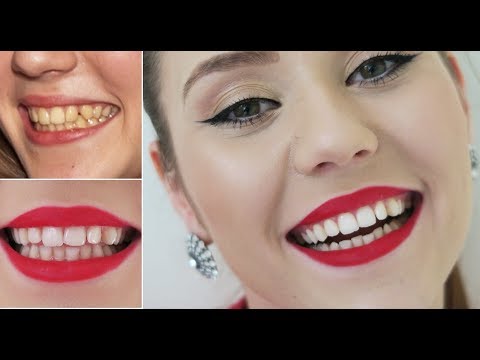 Nu mai vreau dinti galbeni! #cumsaitialbestidintiiacasa