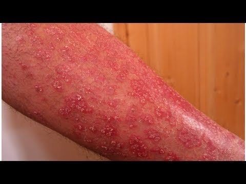 Levotsetirizin a eczema Dermatite di atopic al bambino di 7 anni di una fotografia