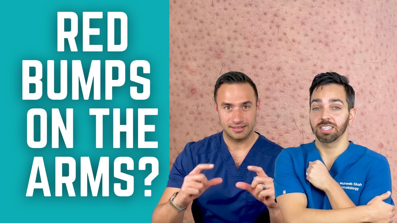 Does Vaseline get rid of keratosis pilaris? More REF