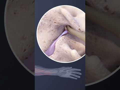 Cervical Radiculopathy