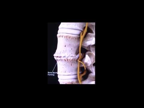 Mal di schiena quando si piega e girare la testa Farmaci di mal di schiena e della colonna vertebrale
