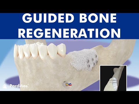 Guided bone regeneration – Bone graft ©