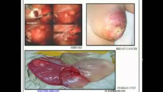 Dangers of Traditional Sanitary Pads (Tampons contains toxic DIOXIN)