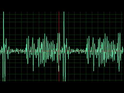 Mitral Stenosis- slow