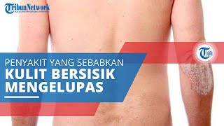 Psoriasis, Peradangan Kulit Ditandai Ruam Merah, Kulit Kering, Tebal, Bersisik, dan Mudah Terkelupas