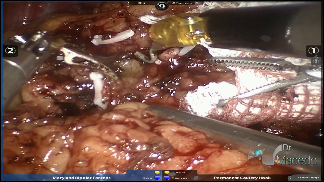 Left Spleno Pancreatectomy for Pancreatic Metastasis of Renal Carcinoma