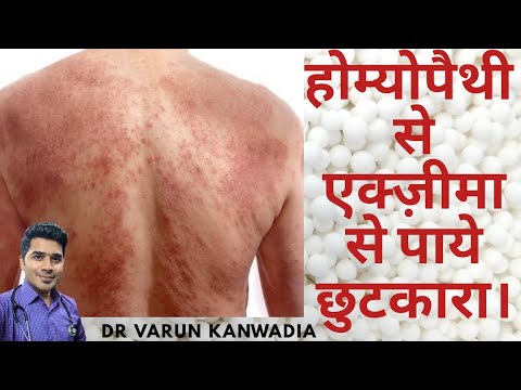Cura di psoriasi in vityazevo Clistere da dermatite atopic