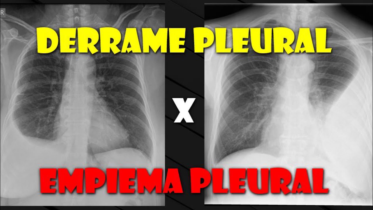 COMO DIFERENCIAR DERRAME PLEURAL E EMPIEMA?