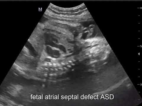 Atrial Septal Defect - ASD