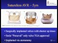 Mr Peter Skillington Choice Timing Of Surgical Procedures On The Aorta Aortic Valve