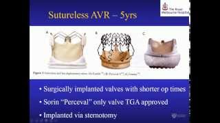 Mr Peter Skillington: Choice & timing of surgical procedures on the aorta & aortic valve
