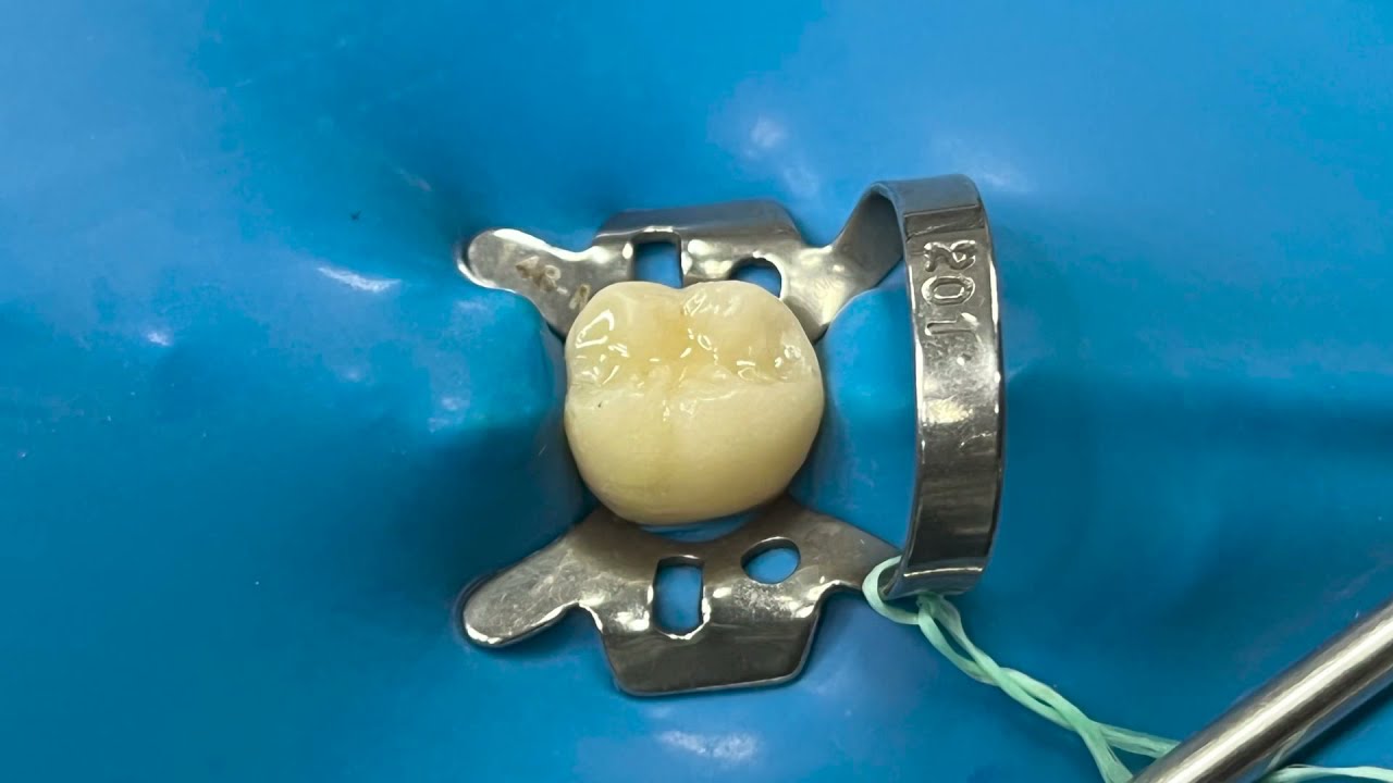 Como aplicar um selante de fóssulas e fissuras com ionômero de vidro modificado por resina?