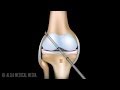 ACL Reconstruction Surgery Animation.