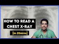 How To Read A Chest X Ray In 20 Mins