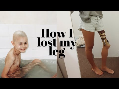 HOW I LOST MY LEG | From 9 year old kid to cancer to amputee.