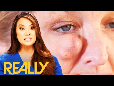 A Massive Cyst Is Blocking Off This Patient's Vision | Dr Pimple Popper