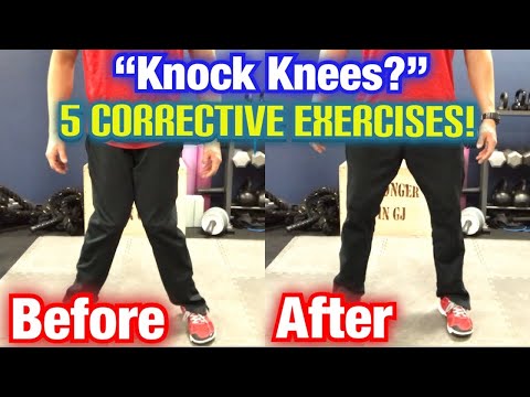 "Knock Knees" *Genu Valgum* 5 BEST CORRECTIVE EXERCISES! | Dr Wil & Dr K