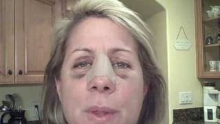 Dr. Nassif Did My New Nose: Day 8