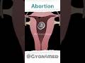 Abortion Animation