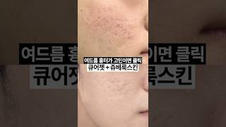 곰보피부 탈출 리얼 후기👀