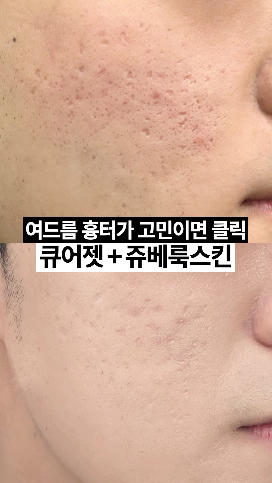 곰보피부 탈출 리얼 후기👀