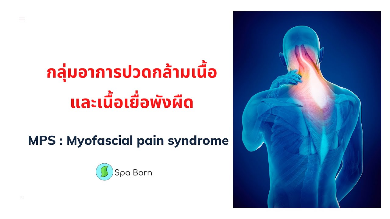 กลุ่มอาการปวดกล้ามเนื้อและเนื้อเยื่อพังผืด MPS (Myofascial pain syndrome)