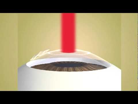 Laser Epithelial Keratomileusis (LASEK)