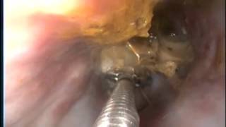 cuerpo extraño esofágico Tomiño