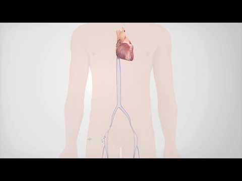 Radiofrequency Catheter Ablation