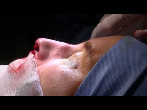 Dorsal Hump Reduction - Nose Surgery