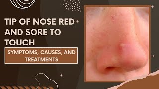 Tip of Nose Red and Sore to Touch | Symptoms, Causes, and Treatments