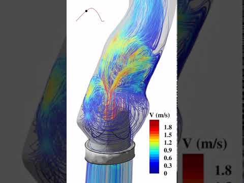 Trileaflet Aortic Valve