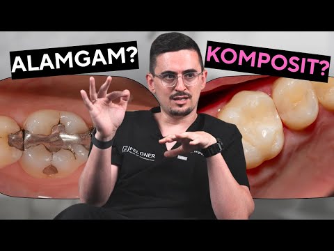 Wie schlecht ist Amalgam wirklich? Was sind die Alternativen? (Amalgam vs. Komposit)