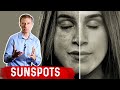 How to Get Rid of Sunspots on Your Skin