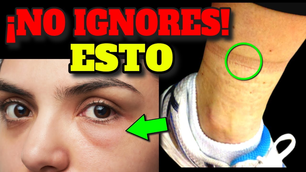 ¡El PELIGRO! por detrás de los EDEMAS que NADIE TE CUENTA| RETENCIÓN de LIQUÍDOS