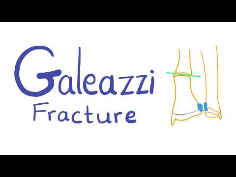 Galeazzi Fracture - Fracture of the Radius Bone 🦴- Orthopedic surgery