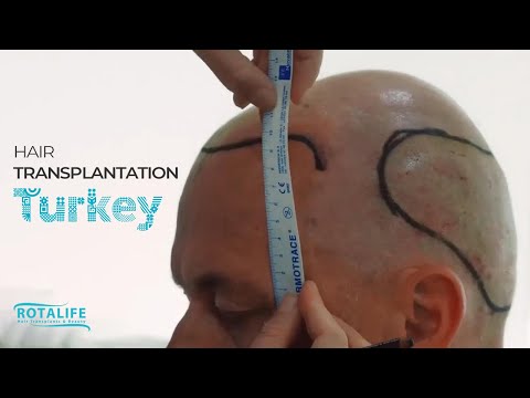 Hair Transplant in Turkey Rotalife