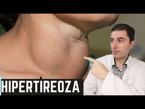 Da li imate UBRZANI RAD ŠTITNJAČE (HIPERTIREOZU)? Ovo su glavni simptomi bolesti...