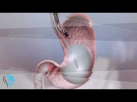 Mide Balonu Nasıl Uygulanır ?