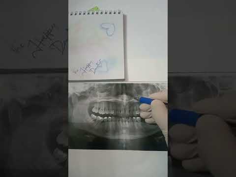 landmarks on OPG (Orthopantomogram)