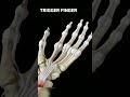 Trigger Finger#triggerfinger #triggers #handanatomy #physicaltherapy #movement #anatomy #shorts