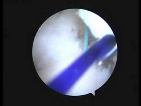 Partial Articular Sided Tendon Avulsions Correction