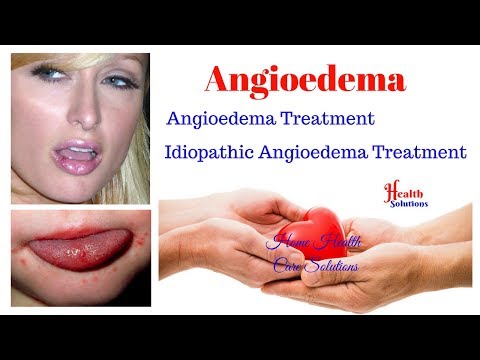 Angioedema - Angioedema Treatment - Idiopathic Angioedema Treatment Video