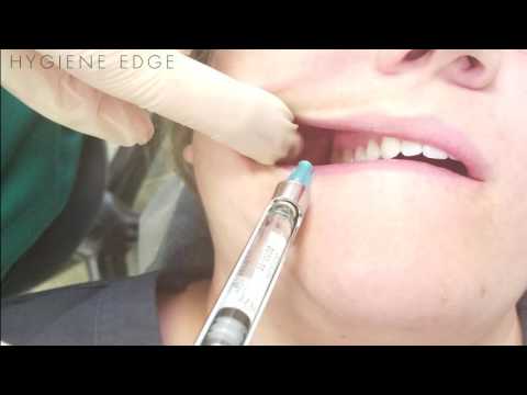 Common Errors on the PSA Injection for Boards