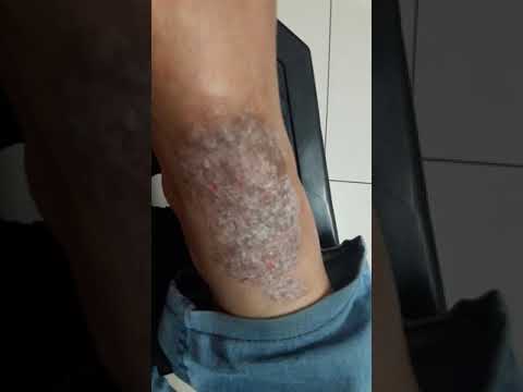 Applicazione di un gluconate di calcio allatto di risposte di psoriasi Il dispositivo da neurodermatitis